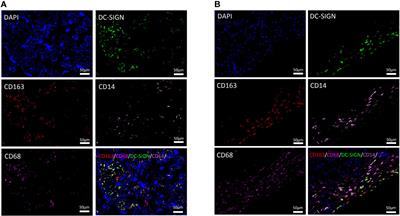 The Distributional Characteristics of M2 Macrophages in the Placental Chorionic Villi are Altered Among the Term Pregnant Women With Uncontrolled Type 2 Diabetes Mellitus